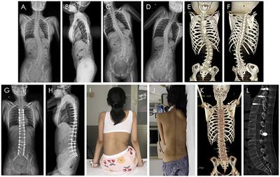 Frontiers Scoliosis Orthopedic Surgery Combined With Nusinersen